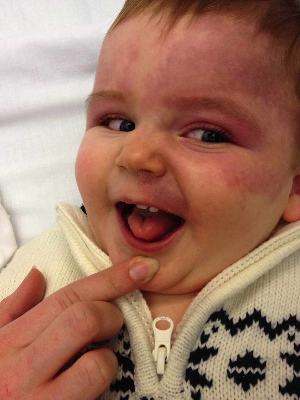 Le portrait de Maxime Syndrome de SturgeWeber Le portrait de Maxime Syndrome de SturgeWeber