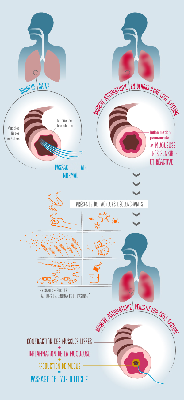 Schéma de l'asthme